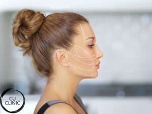 טיפול חוטים נספגים למתיחת פנים וצוואר