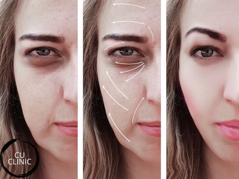 מתיחת פנים ללא ניתוח להרמה ומיצוק העור