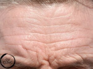 מילוי קמטים בלחיים להחזרת נפח ושיפור מראה העור