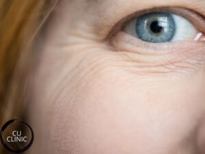 טיפול הצערת העיניים לשיפור מראה אזור העיניים