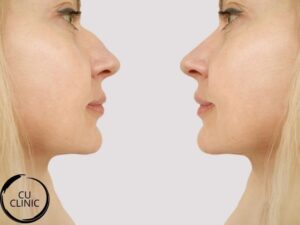 תיקון אף ללא ניתוח לשיפור צורת האף והרמת הקצה