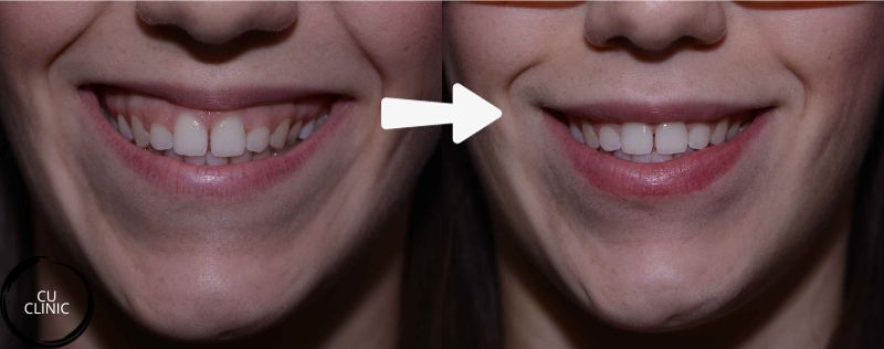 טיפול חיוך חניכיים