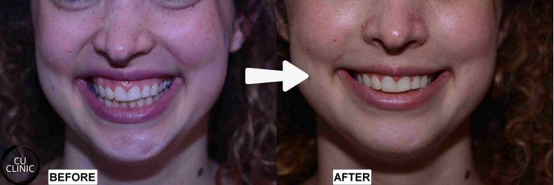 טיפול חיוך חניכיים