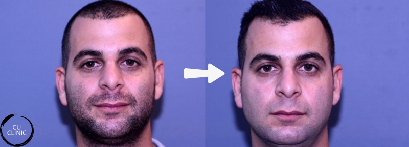 טיפול מילוי שקעים מתחת לעינים