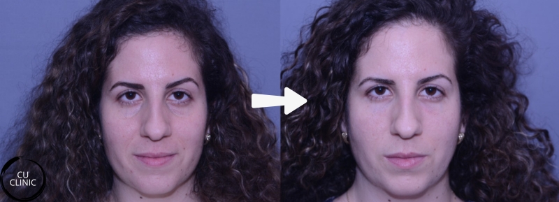 טיפול מילוי שקעים מתחת לעינים