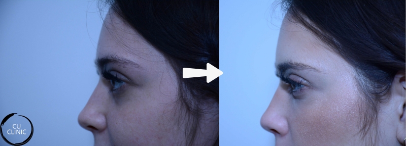 טיפול מילוי שקעים מתחת לעינים