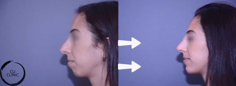 עיצוב הפרופיל לפני ואחרי לשיפור האיזון בין האף, הסנטר והשפתיים