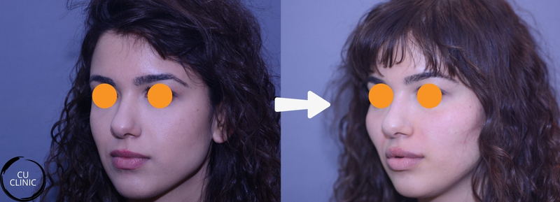 עיצוב לחיים לפני ואחרי להדגשת עצמות הלחיים