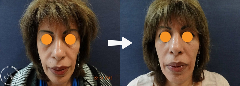 הדגשת עצמות לחיים לפני ואחרי באמצעות הזרקות