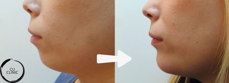 לפני ואחרי עיצוב סנטר באמצעות חומצה היאלורונית