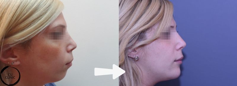 לפני ואחרי עיצוב סנטר באמצעות חומצה היאלורונית