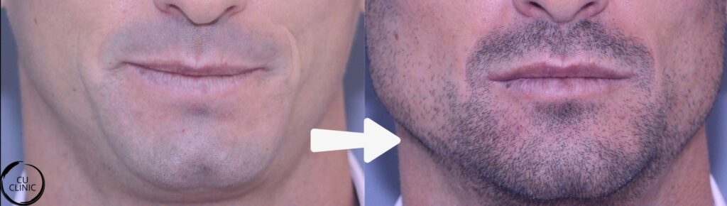 לפני ואחרי עיצוב סנטר באמצעות חומצה היאלורונית