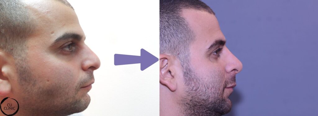 טיפול תיקון אף ללא ניתוח