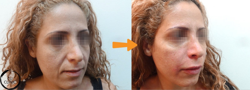 לפני ואחרי פיסול פנים באמצעות חומצה היאלורונית