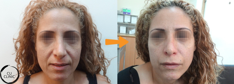 לפני ואחרי פיסול פנים באמצעות חומצה היאלורונית
