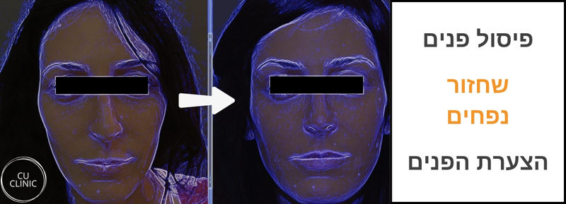 לפני ואחרי פיסול פנים באמצעות חומצה היאלורונית