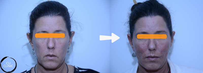 לפני ואחרי פיסול פנים באמצעות חומצה היאלורונית