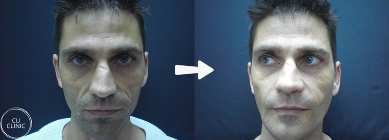 לפני ואחרי פיסול פנים באמצעות חומצה היאלורונית