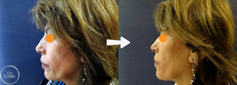 לפני ואחרי פיסול פנים באמצעות חומצה היאלורונית