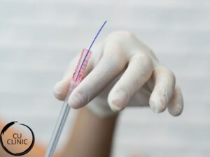 הרמת אף בחוטים נספגים לעיצוב והרמת קצה האף