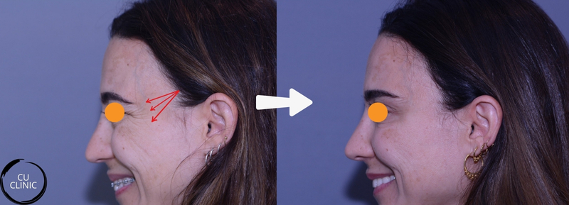 טיפול בוטוקס