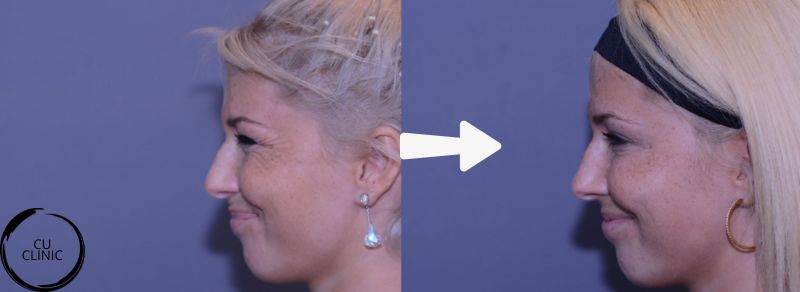 טיפול בוטולינום טוקסין