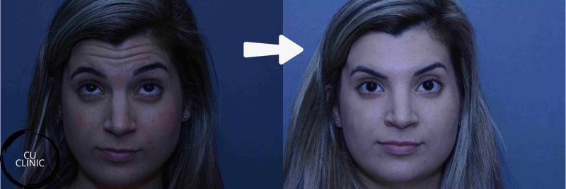 טיפול בוטולינום טוקסין