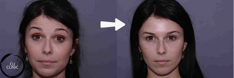 טיפול בוטולינום טוקסין