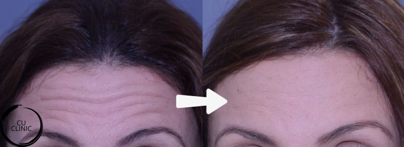 טיפול בוטולינום טוקסין