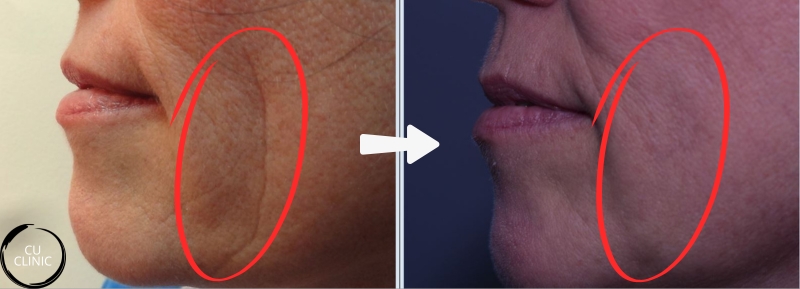 מילוי קמטים בלחיים לפני ואחרי לשיפור מראה העור