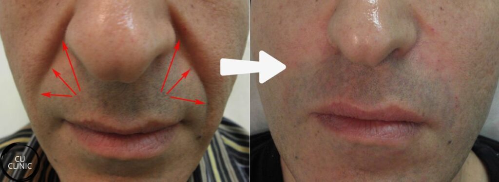 תוצאות מילוי קמטים בצידי האף לפני ואחרי