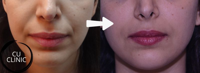 מילוי קמטים בצידי האף תוצאה טבעית