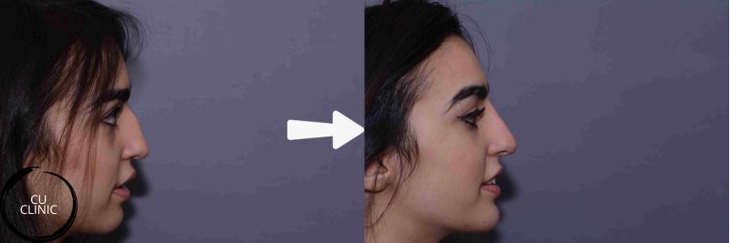 הרמת אף בחוטים לפני ואחרי לשיפור צורת האף והרמת קצה האף