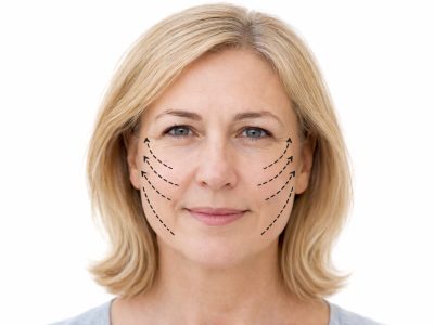 מתיחת פנים ללא ניתוח להרמה ומיצוק העור